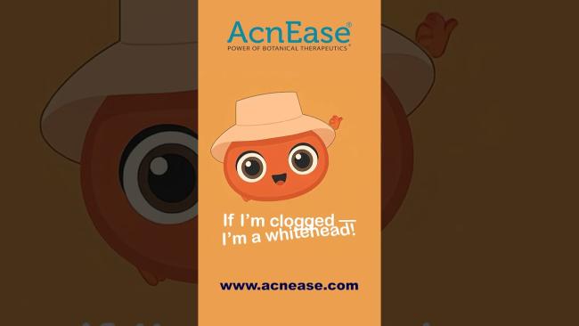 What are Whiteheads and Blackheads, and Can I Do Something About Them??